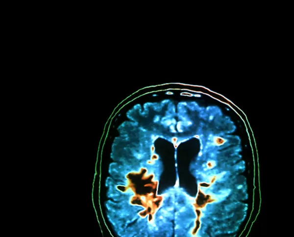 For individuals living with MS, we offer customised investigations and treatment programmes to help you to reduce flare-ups and maintain lasting control over it.